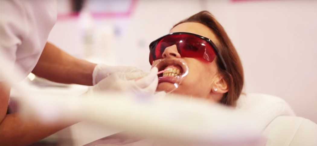 Tanden bleken in de tandartspraktijk met Beyond producten