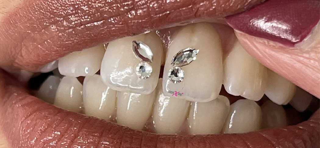 Bijoux Dentaires en Cristal